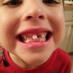 Little boy shows his mouth with missing teeth